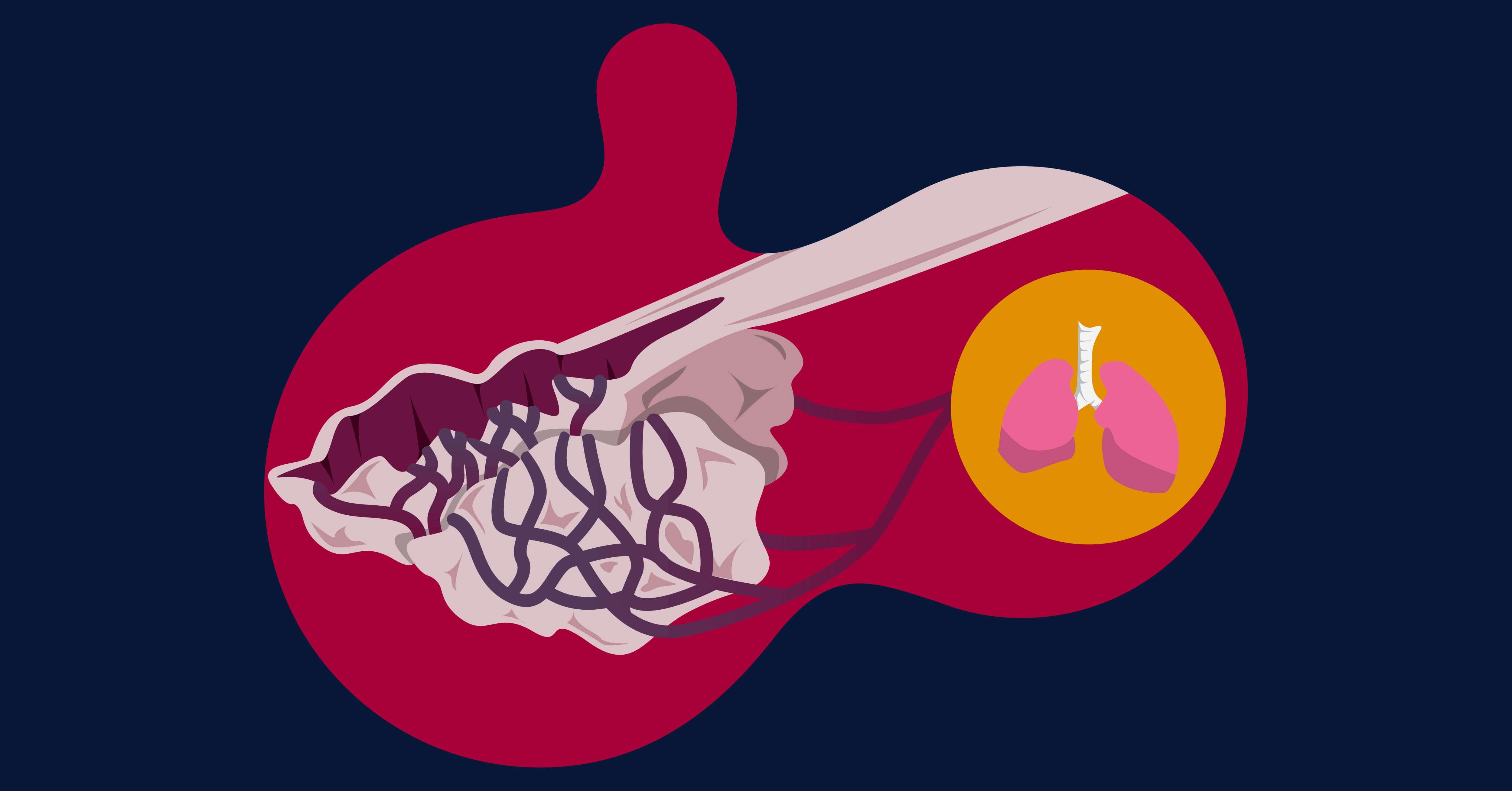 Jangan Salah Ini Diagnosis Atelektasis Yang Perlu Diketahui 64664 Hot