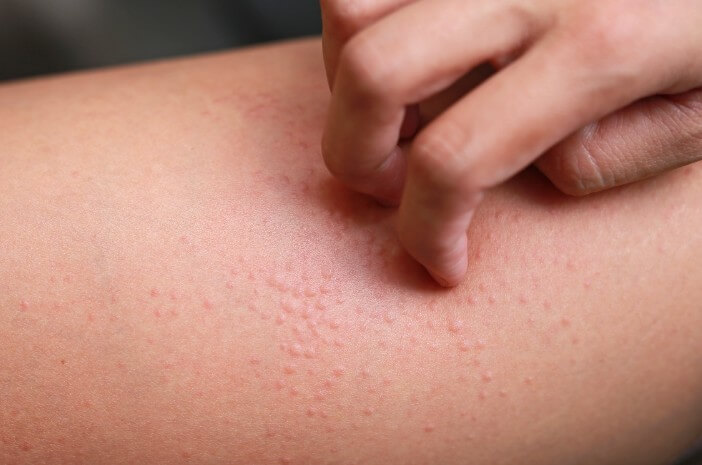 10 Jenis Hematoma, Kumpulan Darah Abnormal di Luar Pembuluh Darah 10 Jenis Hematoma, Kumpulan Darah Abnormal di Luar Pembuluh Darah