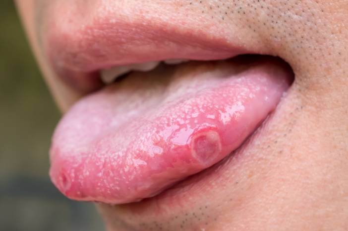 papilloma lidah adalah