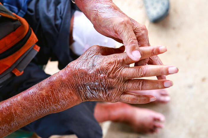 3 Tindakan untuk Mengurangi Dampak Skleroderma