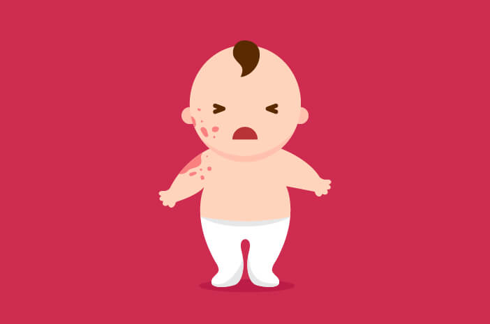 4 Tips untuk Ibu Jika Bayi Alami Dermatitis Atopik