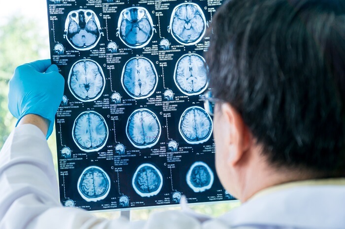 5 Penyakit Ini Lebih Mudah Diketahui dengan MRI
