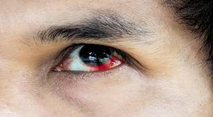 5 Penyebab Bercak Merah pada Mata