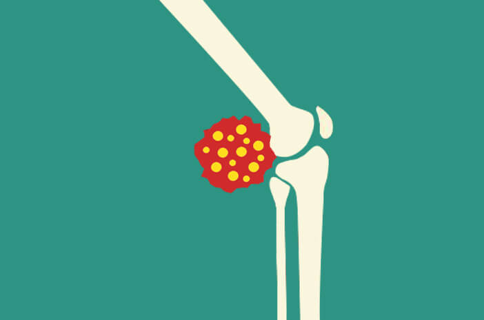 osteosarcoma, gangguan tulang, penyakit keturunan tulang osteosarcoma, gangguan tulang, penyakit keturunan tulang