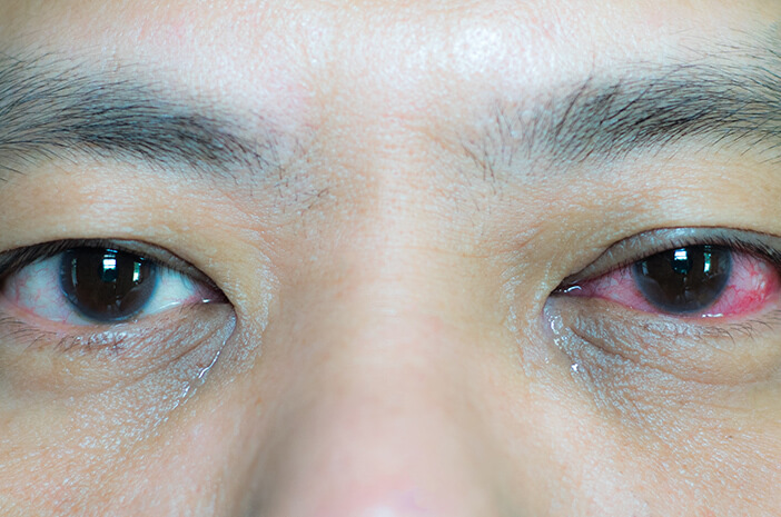 Konjungtivitis Konjungtivitis