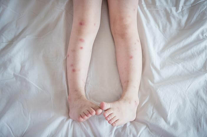pruritus, penyakit pruritus, infeksi jamur pruritus, penyakit pruritus, infeksi jamur