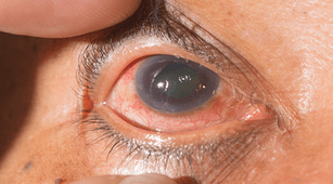 pengobatan glaukoma, penyakit mata