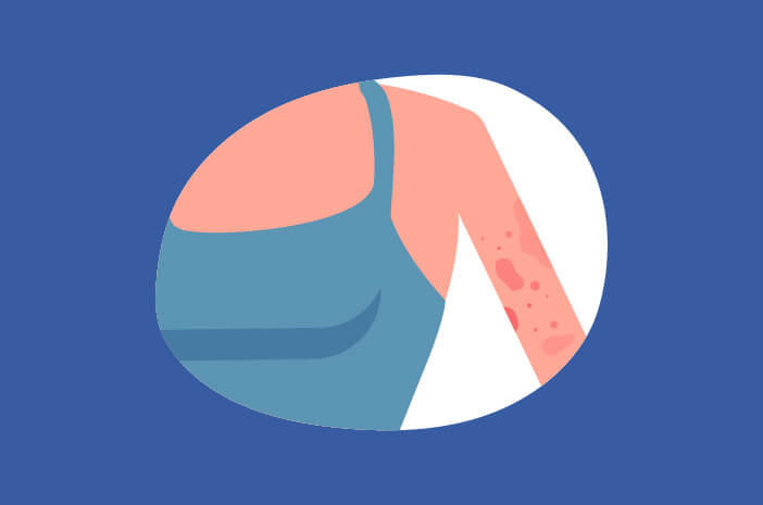 Adakah Pencegahan untuk Penyakit Dermatitis Herpetiformis?