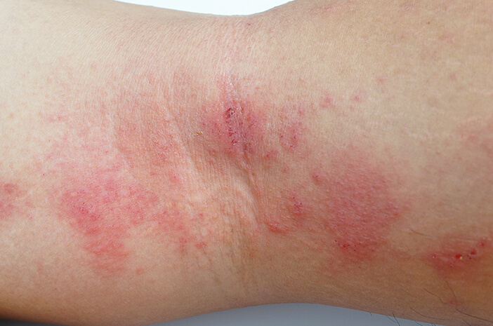 Idap Nekrolisis Epidermal Toksik, Ini Dampak Bagi Tubuh Idap Nekrolisis Epidermal Toksik, Ini Dampak Bagi Tubuh