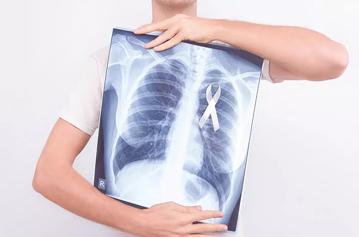TB Paru yang Diabaikan Bisa Menjadi TB Tulang?