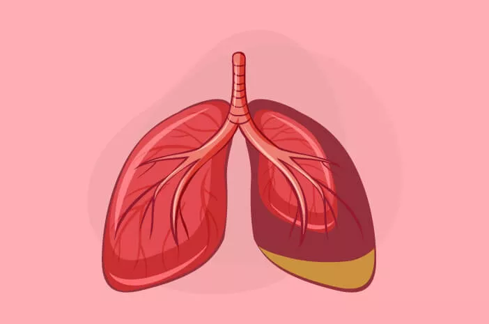 Begini Cara Mendiagnosis Infeksi Saluran Pernapasan