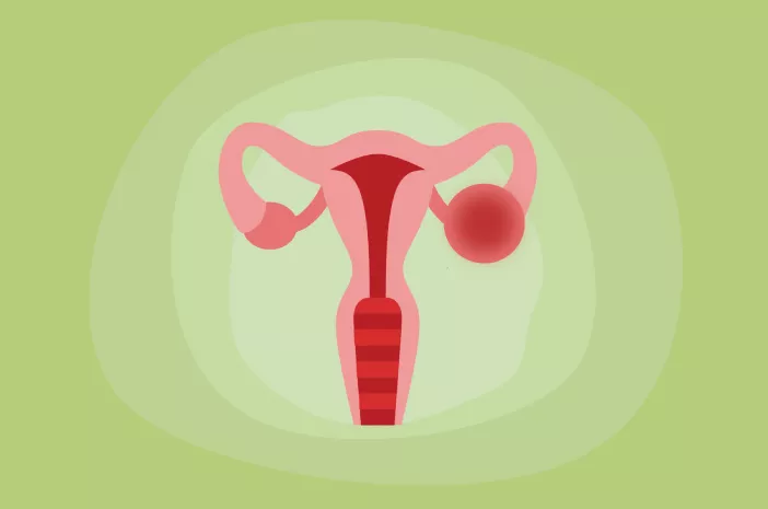 Benarkah Terkena Kista Ovarium Bikin Wanita Sulit Hamil?