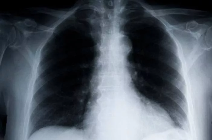 Ini Penyebab Bronkopneumonia yang Perlu Diketahui