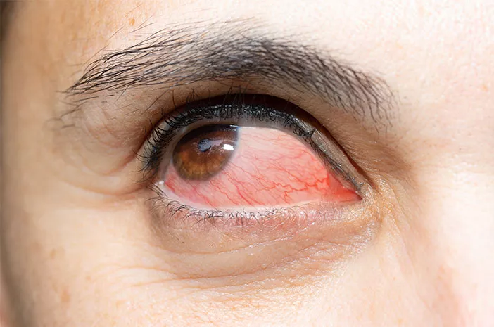 Trauma pada Mata Bisa Sebabkan Keratitis
