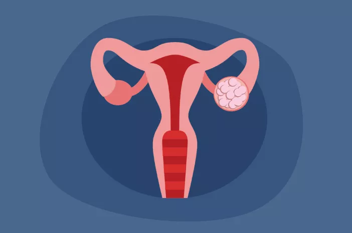 Kista Ovarium Muncul Saat Masa Kehamilan, Apa Saja Risikonya?