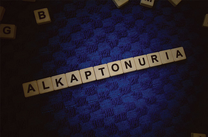 Mitos atau Fakta Alkaptonuria Disebabkan Kelainan Genetik