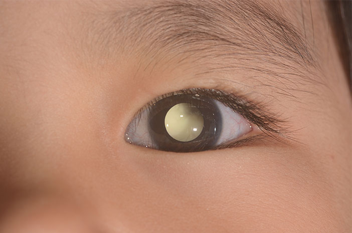 5 Metode Pengobatan untuk Menangani Retinoblastoma