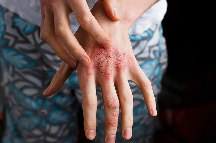 Perenang Rentan Terkena Dermatitis Kontak, Benarkah?