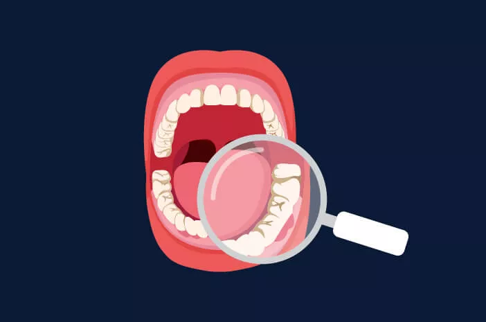 4 Hal yang Terjadi Jika Karang Gigi Tidak Dibersihkan