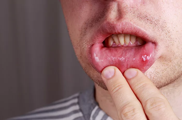 Kenali 7 Penyakit yang Rawan Terjadi di Mulut