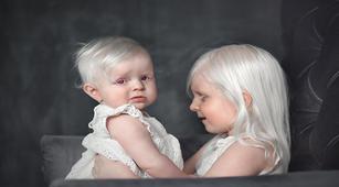 Albino adalah