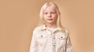 Albinisme Bisa Sebabkan Kanker Kulit, Benarkah?