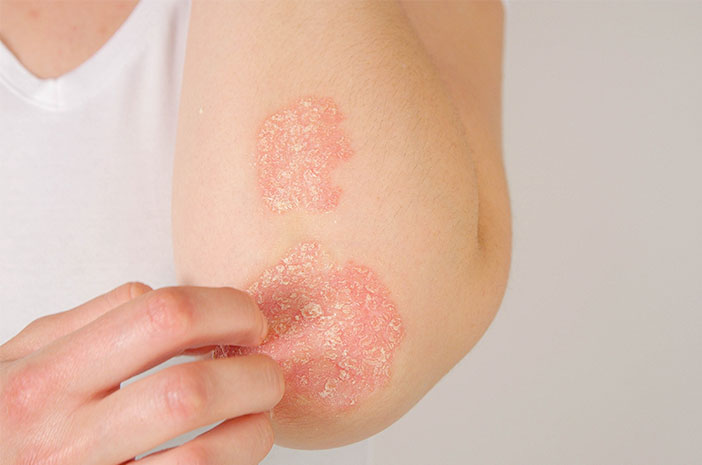 Kulit Kering Bersisik Waspada Gangguan Psoriasis