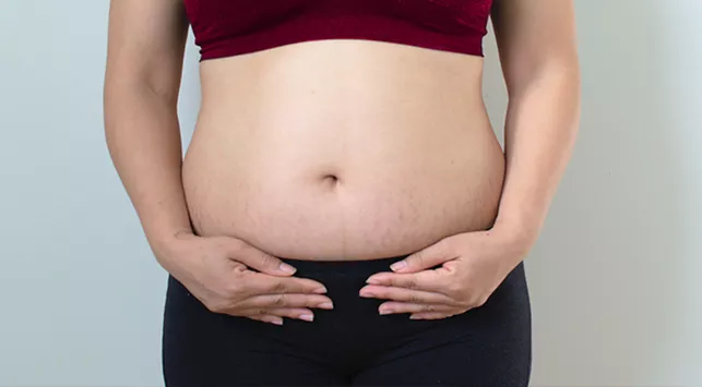 9 Tips Menghilangkan Stretch Mark setelah Kehamilan