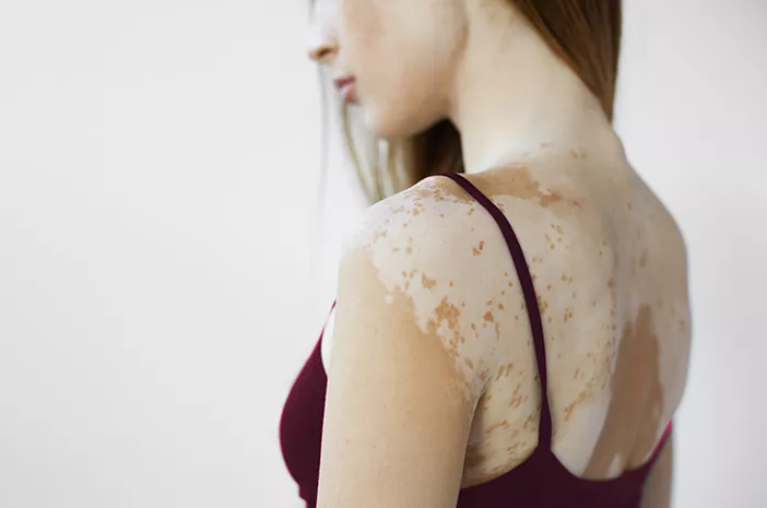 Apakah Vitiligo Dapat Disembuhkan? Ini Faktanya