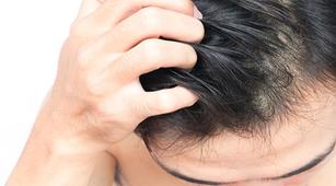 4 Penyebab Terjadinya Infeksi pada Kulit Kepala