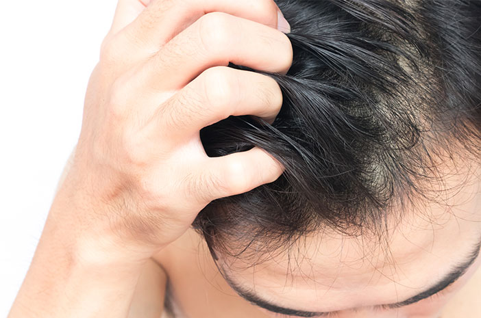 4 Penyebab Terjadinya Infeksi pada Kulit Kepala 