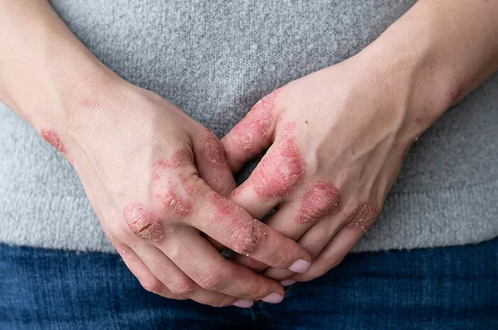 Alasan Penyakit Lupus Bisa Picu Nekrolisis Epidermal Toksik