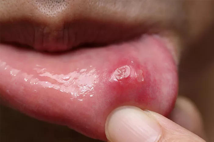 Ini 5 Gangguan Kesehatan Mulut yang Umum Terjadi 