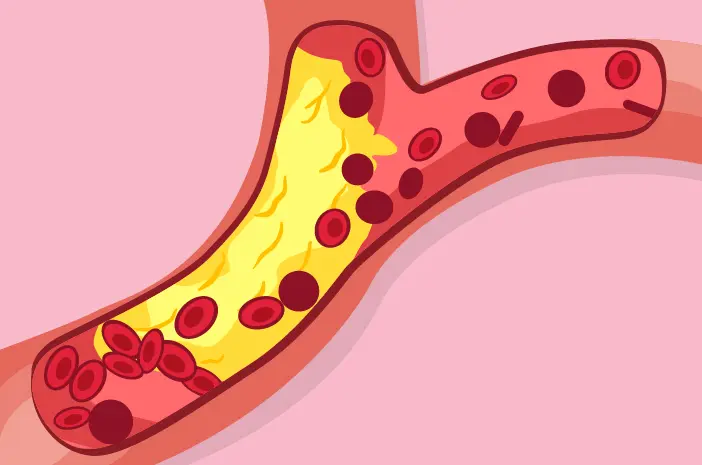 Cara Mengelola Kolesterol Tinggi untuk Pengidap Diabetes