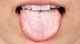 Idap Diabetes Melitus Rentan Terkena Oral Thrush