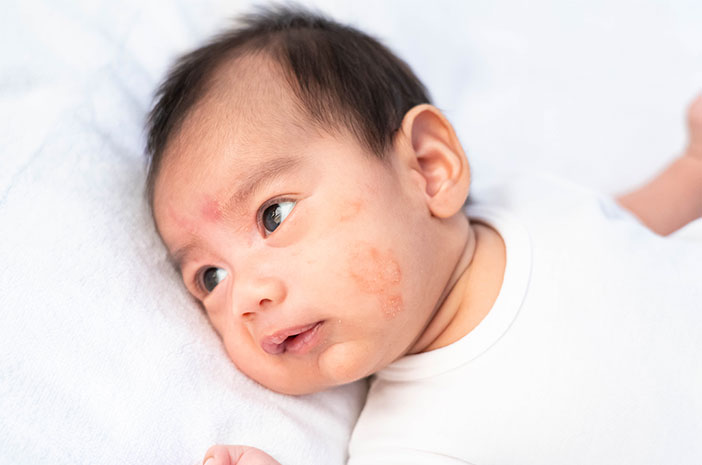 Infeksi Kulit Pada Bayi Bisa Terjadi Karena Alergi Susu Sapi