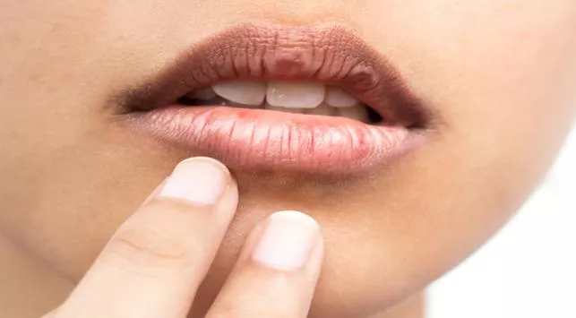 6 Cara Mudah Atasi Bibir Kering Tanpa Lip Balm