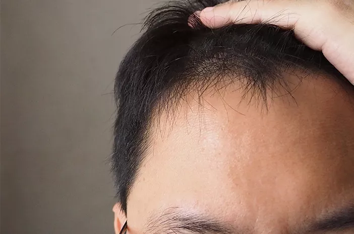 Rambut Rontok Menyerang Pria, Ini Penyebabnya