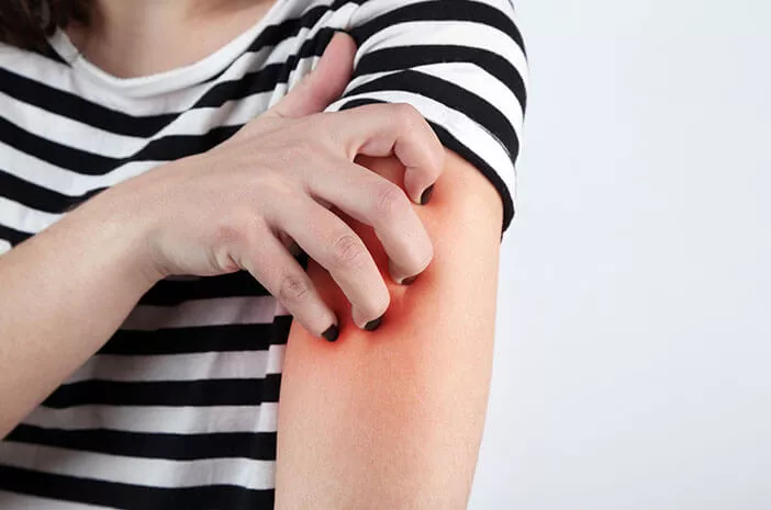8 Faktor Ini Tingkatkan Risiko Dermatitis Numularis 