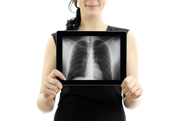 Kenali Tanda-Tanda Bronkitis Menjadi Pneumonia