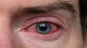 Konjungtivitis Virus, Penyakit Mata Apa Itu?