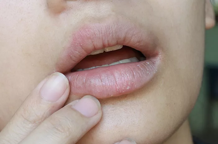 Bibir Kering saat Puasa, Ini Tips untuk Mengatasinya