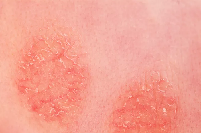 Faktor yang Meningkatkan Risiko Terkena Dermatitis Numularis