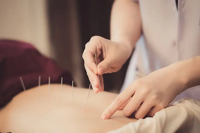 Mitos atau Fakta, Akupunktur Bisa Tingkatkan Kesuburan