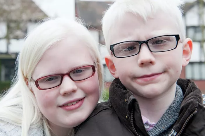 Inilah Dampak Albinisme pada Kondisi Mental Anak