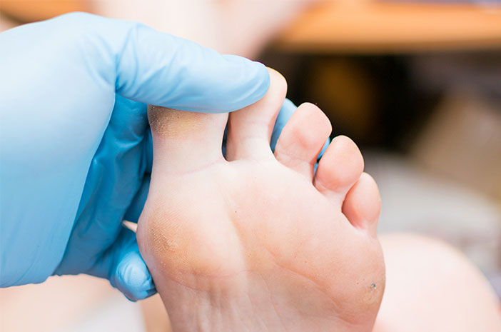 2 Cara Diagnosis untuk Mendeteksi Terjadinya Heloma