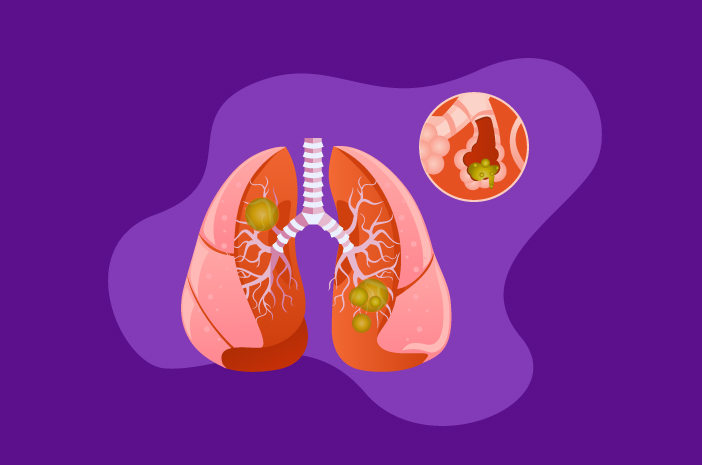 Ketahui Pengobatan Pneumonia Berdasarkan Jenisnya