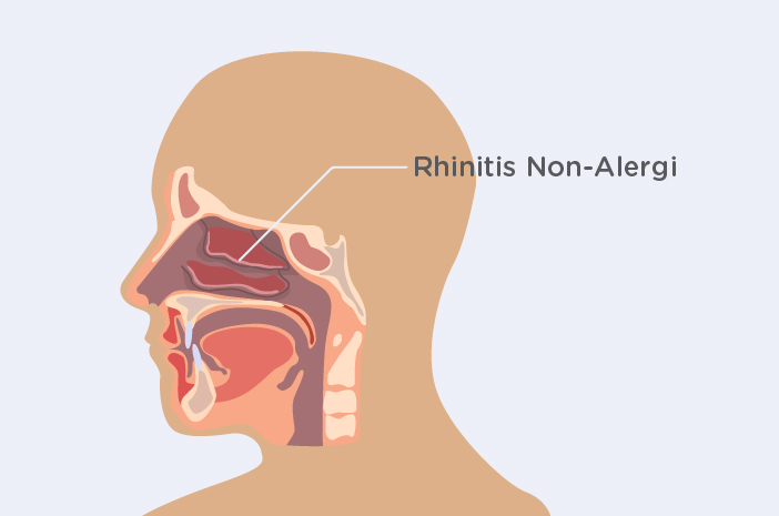 Mengenal Lebih Dekat Rhinitis Non-Alergi
