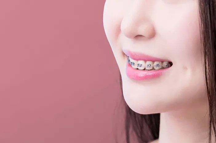 4 Cara Mencegah Sariawan Bagi Pemakai Kawat Gigi