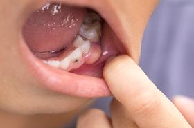 Ketahui 5 Masalah Kesehatan Gigi yang Sering Muncul

